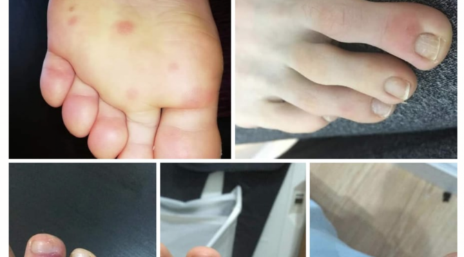 研究人员发现新的新冠症状：脚部病变（图）